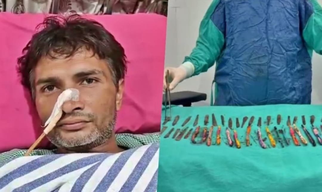 पेट से निकले 29 चम्मच, 19 ब्रश और 2 पेन: Doctor के लिए हैरान करने वाली सर्जरी”