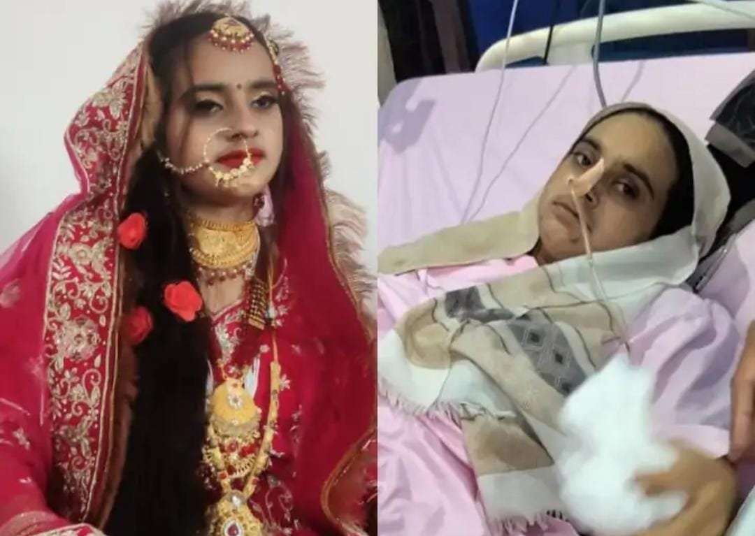 Moradabad: दहेज के लिए ससुरालवालों ने बहू को तेजाब पिलाया, 17 दिन तड़पने के बाद मौत