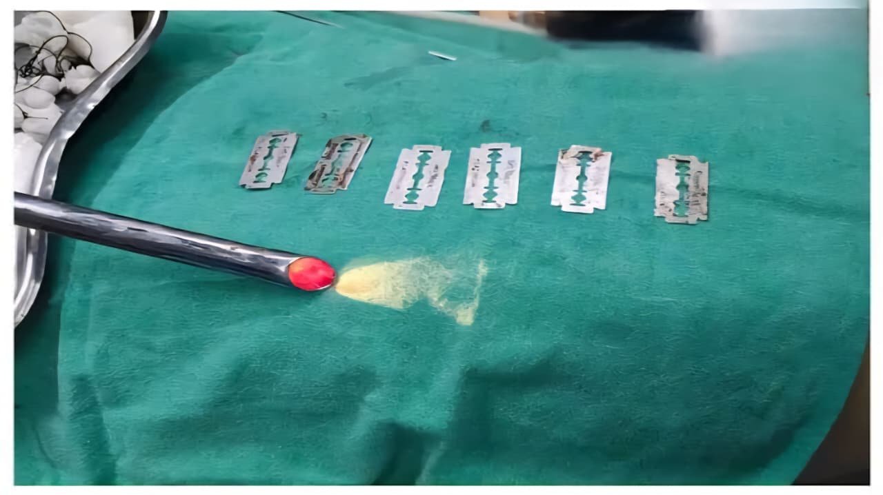 Bilaspur : गलती से निगल गए 6 ब्लेड,  मुंह से बह खून रहा था – Endoscopic से बुजुर्ग की जान बचाई गई