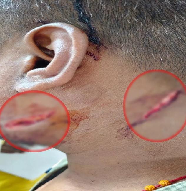 Chhattisgarh: Raipur में युवक पर जानलेवा हमला, गाल और गर्दन पर गंभीर चोटें