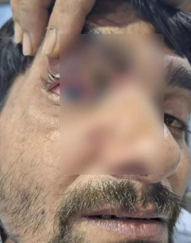 Chhattisgarh: कार्बाइड गन से बढ़ते हादसे, नेत्र विशेषज्ञ ने लगाने की मांग की बैन; सोशल मीडिया ट्रेंड्स को ठहराया जिम्मेदार