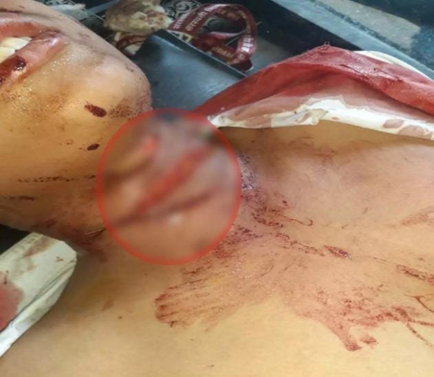 कक्षा 6वीं के छात्र पर धारदार हथियार से हमला, बालक गंभीर रूप से घायल