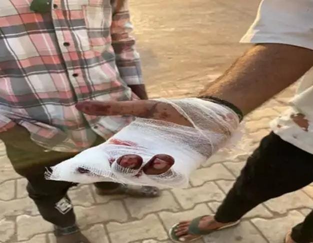 Balod: FIR वापस लेने के दबाव में चाकू से हमला, दो युवक गंभीर घायल