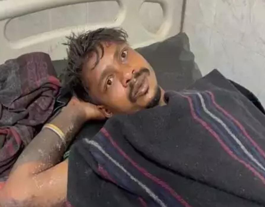 गर्लफ्रेंड से मिलने पहुंचे युवक को भाई ने पेट्रोल डालकर जलाया, तालाब में कूदकर बचाई जान